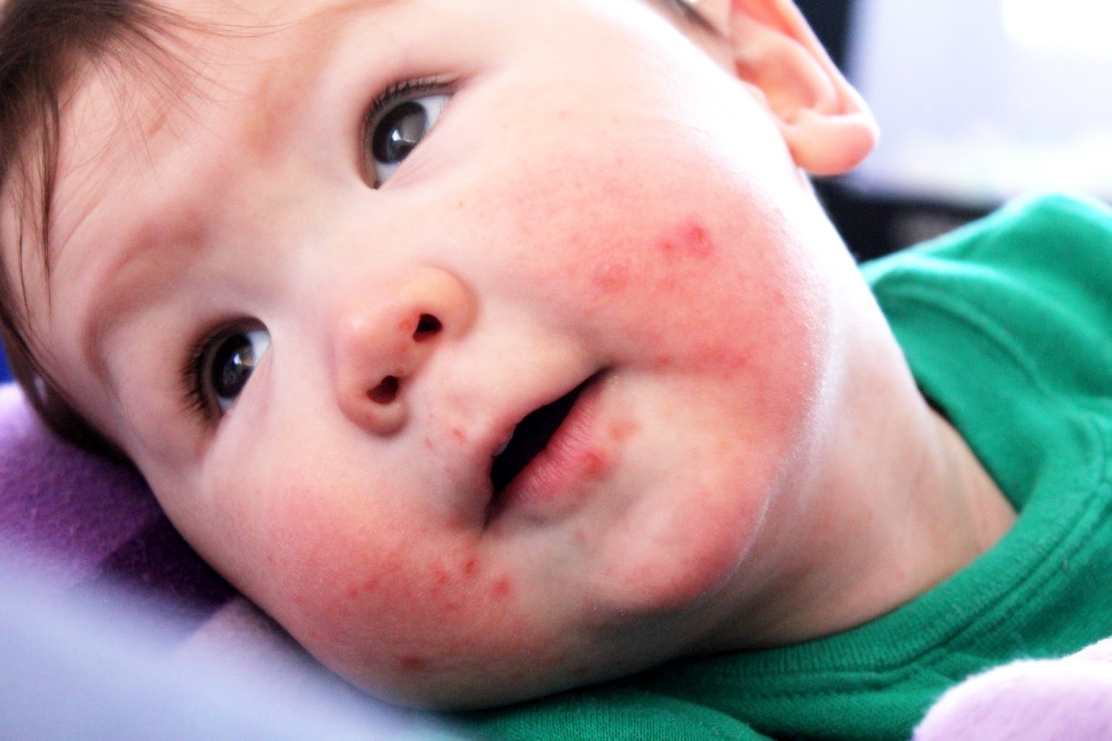 babies hand foot and mouth disease