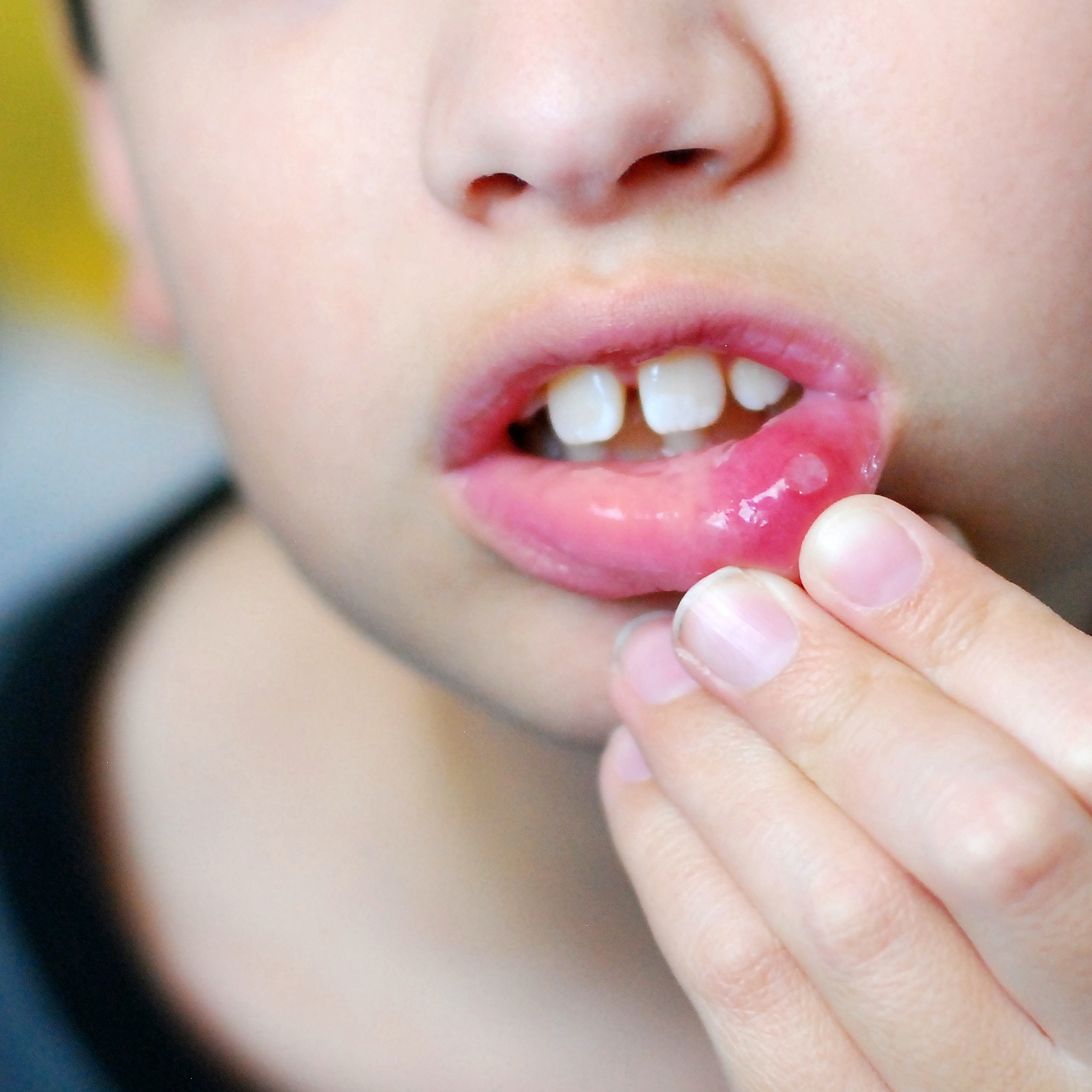 Causes of mouth ulcers - HSE.ie