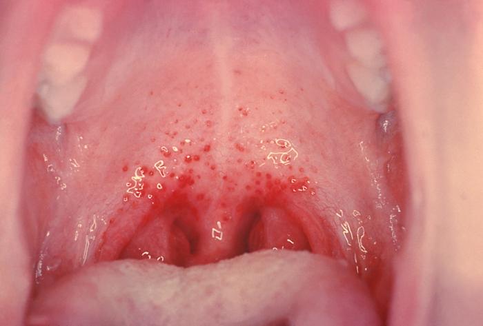 Strep Rash or Viral Scarlatina Rash - Healthy Skin Care