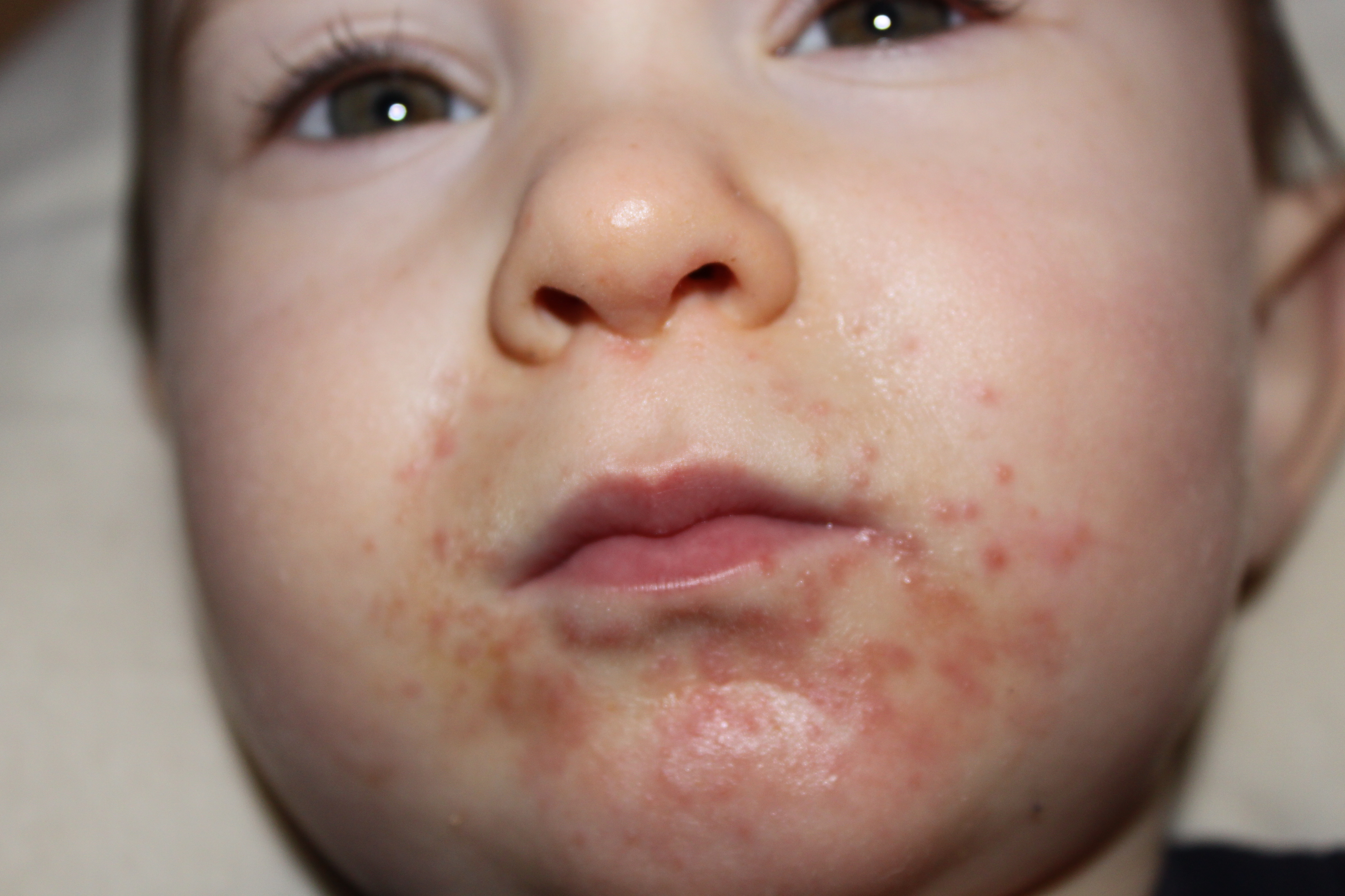 Baby rashes: a visual guide - NHS Choices Home Page