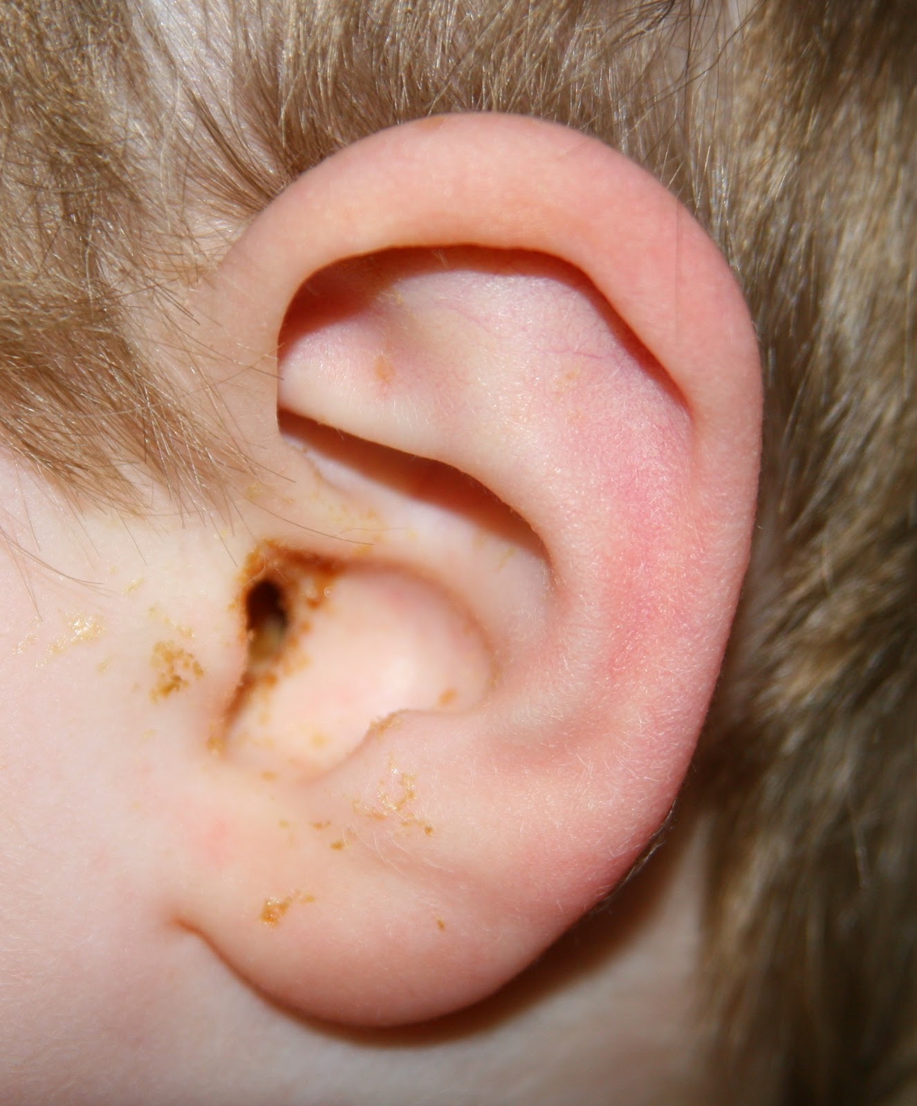 When Do Babies Develop Ear Infections?