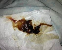 from discharge vagina brown thick