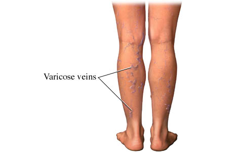 Varicose Veins During Pregnancy - New Kids Center