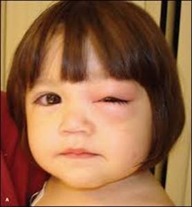 Eye Infection Types, Symptoms & Treatments in Babies - New ...