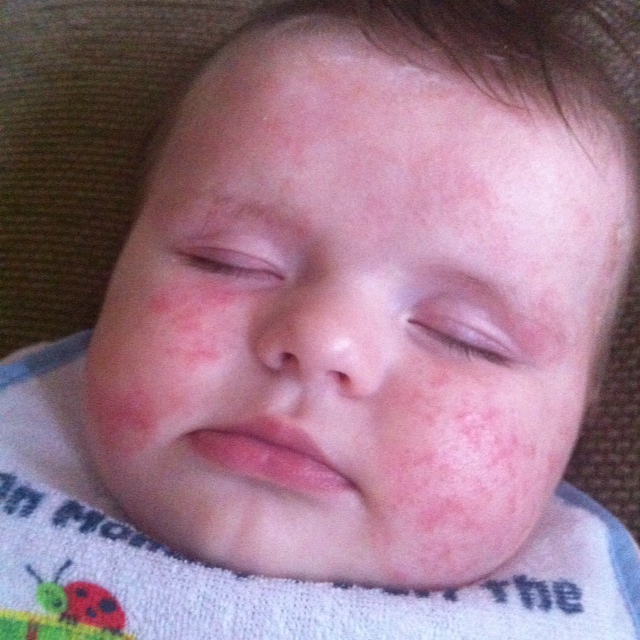 Roseola Rash Pictures - skinsight