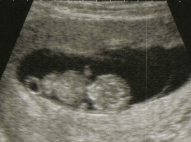 Ultrasound at 8 Weeks: What to Expect - New Kids Center