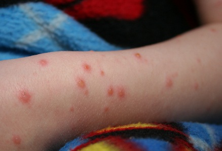 Viral Rash on Babies and Adults: Viral Rash Symptoms and ...