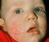 Viral Rashes in Children: Causes, Symptoms & Treatments ...
