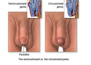 Circumcised penis vs uncircumcised penis