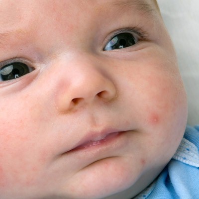 Baby Allergies: Symptoms, Causes, Treatments and Tips ...