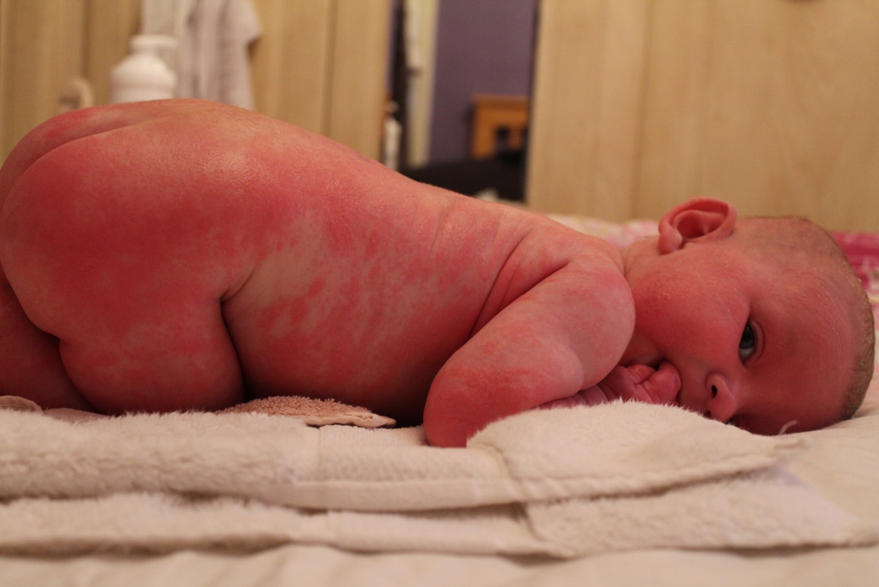Natural Eczema Treatment For Babies Uk Natural Eczema Treatment For Babies Uk