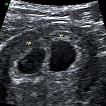 Early Dating Scan At 6 Weeks