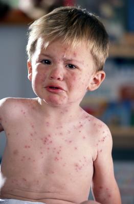 Fever and Rash in Toddlers - New Kids Center