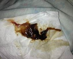 mucus plug pregnancy mucus plug pregnancy