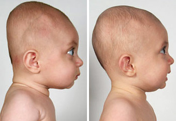 head flat syndrome center image001