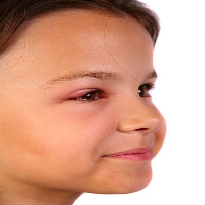 Eye Infection Types, Symptoms & Treatments in Babies - New ...
