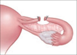 Image result for pregnancy procedure