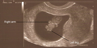 Ultrasound at 8 Weeks: What to Expect - New Kids Center