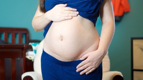 getting a flat belly after c-section