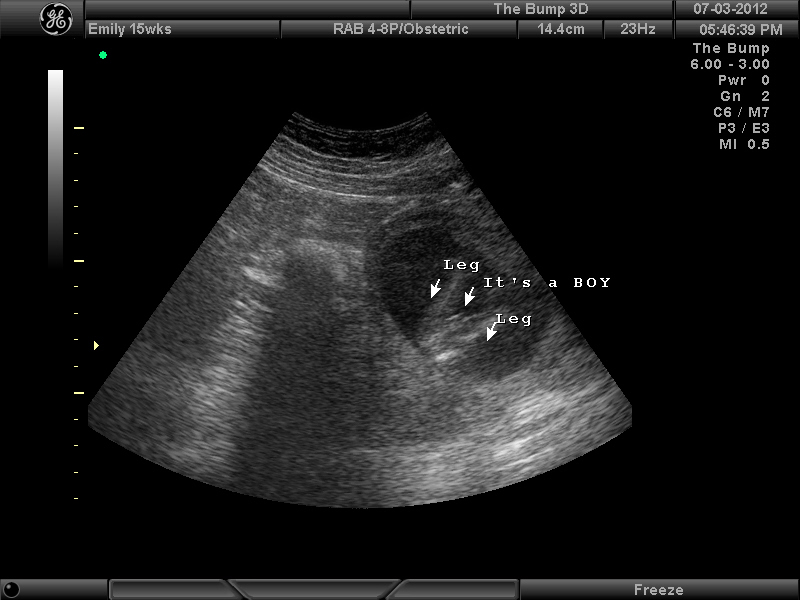 What to Expect in Ultrasound Done at 15 Weeks Pregnant ...