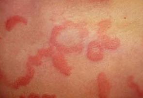 Foods That Can Cause Diaper Rash Foods That Can Cause Diaper Rash